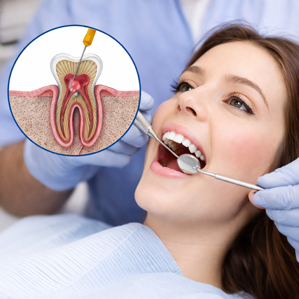 Painless Root Canal Treatment
